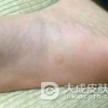 寻常疣患者应该食用哪些食物