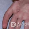 患有寻常疣会出现哪些症状呢