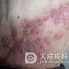 带状疱疹的家庭防治措施