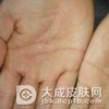 手部湿疹是怎么形成的