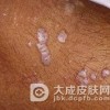 几种与扁平苔癣相伴的几种疾病症状
