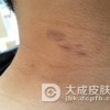 扁平苔癣会带来哪些症状表现呢