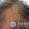 如何预防斑秃的反复发作