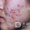 寻常型痤疮的病因是什么