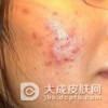 寻常性痤疮的临床症状表现
