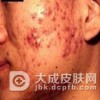 治疗寻常型痤疮的几种药物