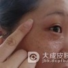 生完宝宝为什么患黄褐斑呢