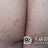 带状疱疹治疗时候要注意什么
