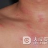 护理生殖器疱疹有哪些要求