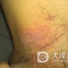 预防疥疮的正确方法都有什么呢
