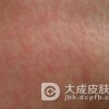 药疹常见的一些临床特点