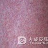 药疹疾病的形成原因有什么啊