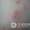 丘疹性荨麻疹预防怎么办