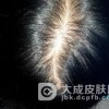 人们对斑秃的错误认识有哪些