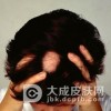斑秃患者应注意哪些事情呢