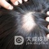 斑秃在早期的时候都有哪些显著的症状