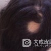 青少年为什么也会得斑秃呢
