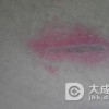 三期梅毒的皮肤损害特征有哪些