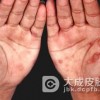 三期梅毒会引发起怎样的症状
