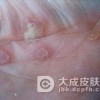 五大三期梅毒症状需知