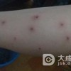 丘疹性荨麻疹的发作特点是什么