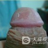 你对淋病的有这样的错误认识吗