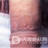 淋病治疗不好反复发作有什么损害