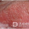 治愈淋病有什么需要注意的问题
