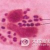 淋病患者可以生育健康婴儿吗