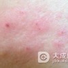 脂溢性皮炎怎么与辨别呢