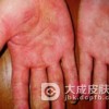 手部湿疹的发病症状表现有哪些