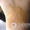 手部湿疹有哪些明显症状