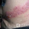 带状疱疹带来的困扰不言而喻