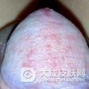 淋病的是通过什么方式传播的