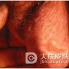 淋病对患者心理的影响有哪些