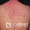 专家解析红斑狼疮早期的症状