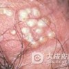 淋病患者怎么保健好