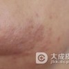 三期梅毒的临床表现有哪一些呢