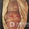 三期梅毒会对患者体内造成什么症状危害