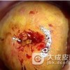 怎么治疗三期梅毒才能避免恶化