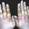 手癣与湿疹的症状表现和区别