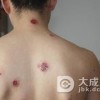 三期梅毒是怎样的呢