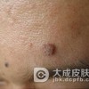 寻常疣的症状及诊断