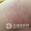 诱发胎记的几大因素是什么