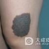 红色胎记有什么样的表现呢