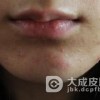 白头粉刺怎样日常治疗呢