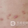 结节性痒疹该如何预防呢