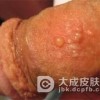 男性生殖器疱疹有什么严重危害