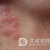 带状疱疹的发病规律有哪些呢