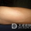 常见的四种药疹特点会有什么